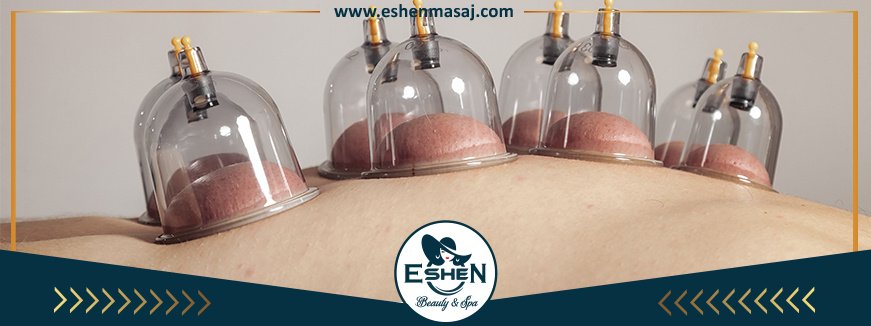 Çorlu Cupping Masajı
